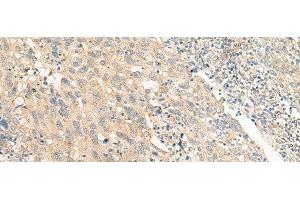 Immunohistochemistry of paraffin-embedded Human cervical cancer tissue using CHP1 Polyclonal Antibody at dilution of 1:25(x200) (CHP antibody)