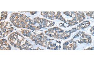 Immunohistochemistry of paraffin-embedded Human esophagus cancer tissue using GULP1 Polyclonal Antibody at dilution of 1:65(x200) (GULP1 antibody)