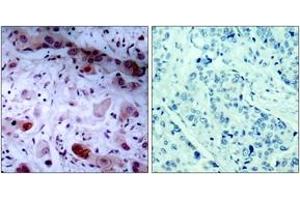 Immunohistochemistry analysis of paraffin-embedded human breast carcinoma, using JAK1 (Phospho-Tyr1022) Antibody.