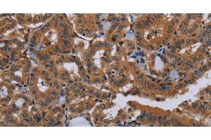 Immunohistochemistry of paraffin-embedded Human thyroid cancer tissue using NPTX1 Polyclonal Antibody at dilution 1:50 (NPX1 antibody)