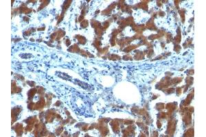 Formalin-fixed, paraffin-embedded human Hepatocellular Carcinoma stained with RBP1 (RBP/872) (RBP1 antibody)