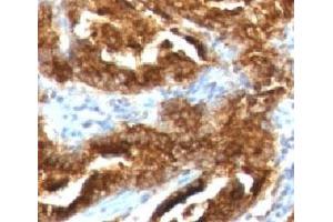 IHC testing of human prostate carcinoma with TAG-72 antibody (CA72/733).