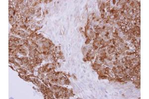 IHC-P Image Profilin 2 antibody detects PFN2 protein at cytoplasm on human colon carcinoma by immunohistochemical analysis.