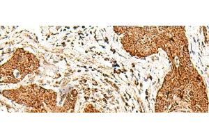 Immunohistochemistry of paraffin-embedded Human esophagus cancer tissue using SMOC1 Polyclonal Antibody at dilution of 1:50(x200) (SMOC1 antibody)