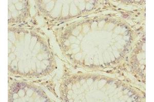 Immunohistochemistry of paraffin-embedded human colon cancer using ABIN7147204 at dilution of 1:100 (CD97 antibody  (AA 240-435))