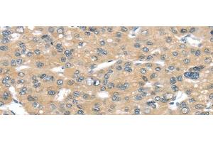 Immunohistochemistry of paraffin-embedded Human liver cancer tissue using TUSC2 Polyclonal Antibody at dilution 1:50 (TUSC2 antibody)