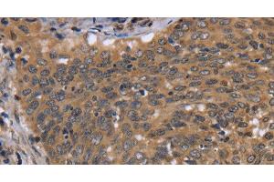 Immunohistochemistry of paraffin-embedded Human cervical cancer using FGFR1OP Polyclonal Antibody at dilution of 1:40 (FGFR1OP antibody)