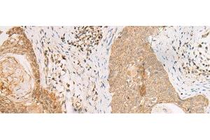 Immunohistochemistry of paraffin-embedded Human esophagus cancer tissue using PAX5 Polyclonal Antibody at dilution of 1:30(x200) (PAX5 antibody)
