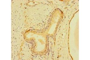 Immunohistochemistry of paraffin-embedded human prostate cancer using ABIN7176381 at dilution of 1:100 (ZNF56 antibody  (AA 186-395))