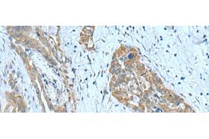 Immunohistochemistry of paraffin-embedded Human thyroid cancer tissue using SRPK2 Polyclonal Antibody at dilution of 1:90(x200) (SRPK2 antibody)