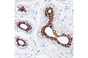 Immunohistochemistry of paraffin-embedded human breast cancer using MT-ND5 antibody (ABIN7268603) at dilution of 1:100 (40x lens). (MT-ND5 antibody  (C-Term))