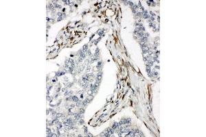 Anti-DR5 antibody, IHC(P) IHC(P): Human Lung Cancer Tissue (TNFRSF10B antibody  (C-Term))