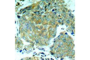 Immunohistochemistry of paraffin-embedded human breast carcinoma using Phospho-eIF2α-S51 antibody (ABIN2987989). (EIF2S1 antibody  (pSer51))
