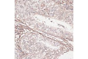 Immunohistochemistry of paraffin-embedded human uterine cancer using L antibody (ABIN7268186) at dilution of 1:100 (40x lens). (Laminin gamma 1 antibody  (AA 1300-1609))