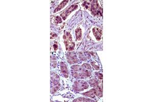 Immunohistochemical analysis of paraffin-embedded human breast carcinoma (A) and liver carcinoma (B) tissue, showing cytoplasmical localization, using BCL10 monoclonal antibody, clone 4F8E8H8  with DAB staining.