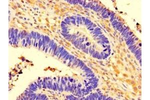 Immunohistochemistry of paraffin-embedded human ovarian cancer using ABIN7148172 at dilution of 1:100 (CCDC91 antibody  (AA 1-180))