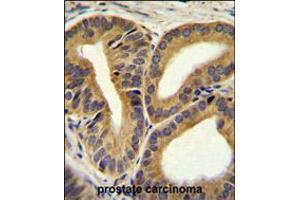 TRIM65 Antibody immunohistochemistry analysis in formalin fixed and paraffin embedded human prostate carcinoma followed by peroxidase conjugation of the secondary antibody and DAB staining. (TRIM65 antibody  (AA 327-355))