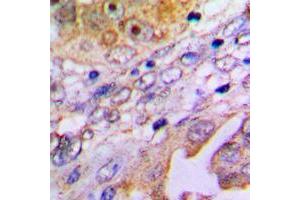 Immunohistochemical analysis of MP68 staining in human lung cancer formalin fixed paraffin embedded tissue section. (C14orf2 antibody  (Center))