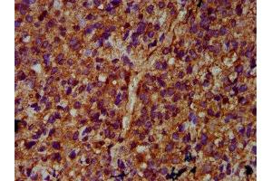 IHC image of ABIN7169209 diluted at 1:400 and staining in paraffin-embedded human glioma performed on a Leica BondTM system. (ULK2 antibody  (AA 211-276))