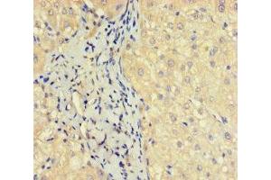 Immunohistochemistry of paraffin-embedded human liver cancer using ABIN7162135 at dilution of 1:100 (OBP2A antibody  (AA 16-170))