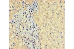 Immunohistochemistry of paraffin-embedded human liver cancer using ABIN7162135 at dilution of 1:100 (OBP2A antibody  (AA 16-170))