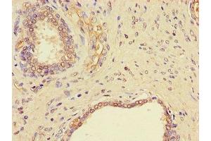 Immunohistochemistry of paraffin-embedded human prostate cancer using ABIN7145523 at dilution of 1:100 (Nerve Growth Factor antibody  (AA 122-218))