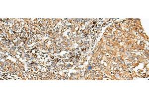 Immunohistochemistry of paraffin-embedded Human cervical cancer tissue using STT3A Polyclonal Antibody at dilution of 1:70(x200) (STT3A antibody)