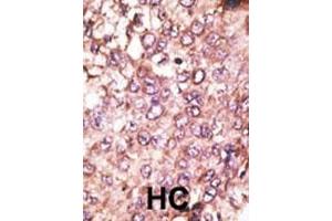 Formalin-fixed and paraffin-embedded human cancer tissue reacted with the primary antibody, which was peroxidase-conjugated to the secondary antibody, followed by AEC staining. (ATG4C antibody  (AA 167-196))