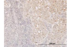 Immunoperoxidase of monoclonal antibody to CFL1 on formalin-fixed paraffin-embedded human breast cancer. (Cofilin antibody  (AA 1-166))