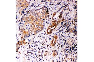 Anti-Annexin A10 antibody, IHC(P) IHC(P): Human Lung Cancer Tissue (Annexin a10 antibody  (C-Term))