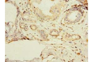 Immunohistochemistry of paraffin-embedded human breast cancer using ABIN7163030 at dilution of 1:100 (PSD4 antibody  (AA 1-300))