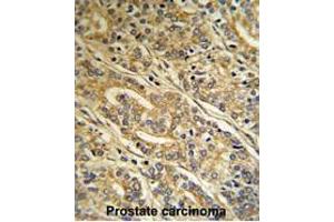 Formalin-fixed and paraffin-embedded human Prostate carcinoma reacted with ACOT8 Antibody (C-term), which was peroxidase-conjugated to the secondary antibody, followed by DAB staining. (ACOT8 antibody  (C-Term))