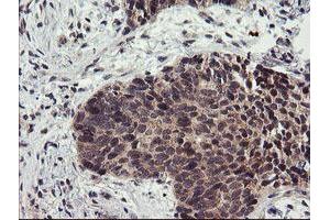 Immunohistochemical staining of paraffin-embedded Carcinoma of Human lung tissue using anti-LRRC25 mouse monoclonal antibody. (LRRC25 antibody)