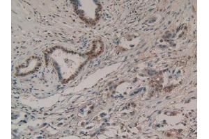 IHC-P analysis of Human Pancreas Cancer Tissue, with DAB staining. (EZH2 antibody  (AA 51-285))