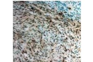 Twist1 Antibody staining Twist in Mouse pancreatic cancer tissue sections by Immunohistochemistry (TWIST1 antibody)