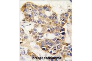 Formalin-fixed and paraffin-embedded human breast carcinoma tissue reacted with P9 antibody (C-term) (ABIN390154 and ABIN2840653) , which was peroxidase-conjugated to the secondary antibody, followed by DAB staining. (MMP 9 antibody  (C-Term))