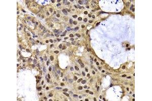 Immunohistochemistry of paraffin-embedded Human oophoroma using ARID3A Polyclonal Antibody at dilution of 1:100 (40x lens). (ARID3A antibody)