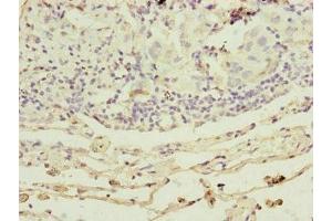 Immunohistochemistry of paraffin-embedded human lung cancer using ABIN7164324 at dilution of 1:100 (RARS2 antibody  (AA 17-340))
