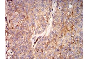 Immunohistochemical analysis of paraffin-embedded bladder cancer tissues using RALB mouse mAb with DAB staining. (RALB antibody  (AA 89-206))