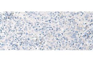 Immunohistochemistry of paraffin-embedded Human cervical cancer tissue using STAU2 Polyclonal Antibody at dilution of 1:45(x200) (Double-stranded RNA-binding protein Staufen homolog 2 (STAU2) antibody)