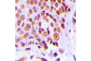 Immunohistochemical analysis of C/EBP gamma staining in human breast cancer formalin fixed paraffin embedded tissue section. (CEBPG antibody)