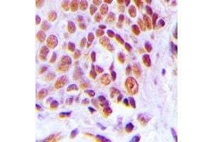 Immunohistochemical analysis of C/EBP gamma staining in human breast cancer formalin fixed paraffin embedded tissue section. (CEBPG antibody)