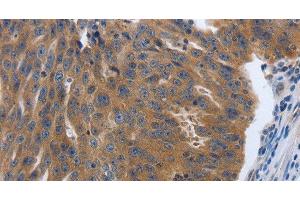 Immunohistochemistry of paraffin-embedded Human ovarian cancer tissue using PDGFA Polyclonal Antibody at dilution 1:70 (PDGFA antibody)