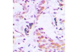 Immunohistochemical analysis of TCEB3C staining in human breast cancer formalin fixed paraffin embedded tissue section. (TCEB3C antibody  (C-Term))