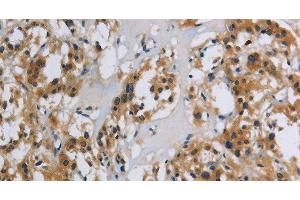 Immunohistochemistry of paraffin-embedded Human thyroid cancer using SYN1 Polyclonal Antibody at dilution of 1:40 (SYN1 antibody)
