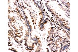 IHC-P: BAG3 antibody testing of human intestine cancer tissue