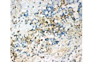 IHC-P: CD63 antibody testing of human intestinal cancer tissue (CD63 antibody  (AA 97-238))