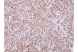IHC-P Image Immunohistochemical analysis of paraffin-embedded MDA-MB-231 xenograft, using Profilin 1, antibody at 1:500 dilution. (PFN1 antibody)