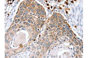 The image on the left is immunohistochemistry of paraffin-embedded Human esophagus cancer tissue using ABIN7130898(RNF185 Antibody) at dilution 1/20, on the right is treated with fusion protein. (RNF185 antibody)