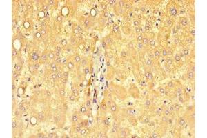 Immunohistochemistry of paraffin-embedded human liver cancer using ABIN7149746 at dilution of 1:100 (DSE antibody  (AA 23-270))